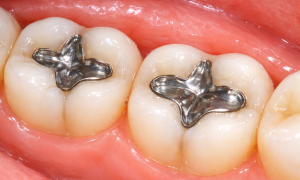 유해중금속 수은 함유 치과 아말감 폐기물 여전히 관리 사각지대